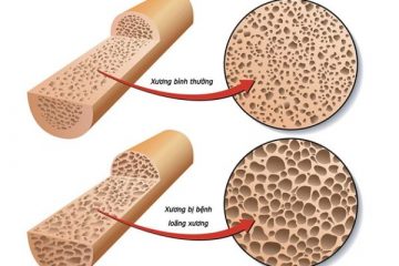 Bệnh loãng xương là gì?