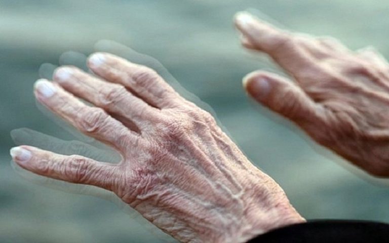 Bệnh parkinson là gì?