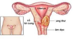 Bệnh ung thư cổ tử cung là gì?