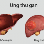 Bệnh ung thư gan là gì?