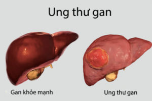 Bệnh ung thư gan là gì?