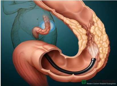 Bệnh ung thư ruột kết là gì?