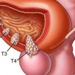 Bệnh ung thư tiền liệt là gì?