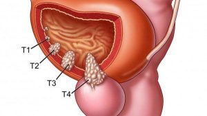 Bệnh ung thư tiền liệt là gì?