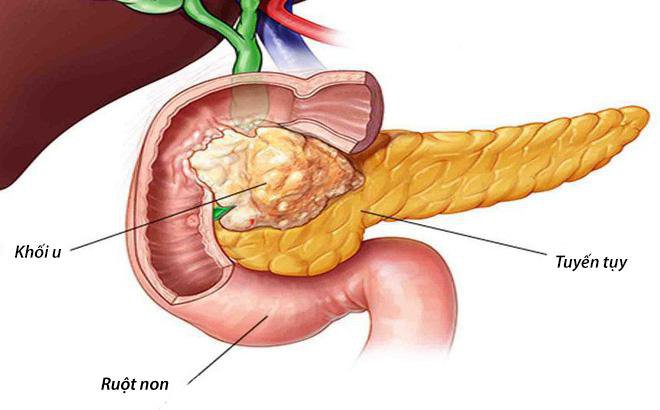 Bệnh ung thư tụy là gì?