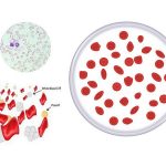 Bệnh Thalassemia là bệnh gì?