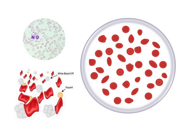 Bệnh Thalassemia là bệnh gì?