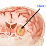 Bệnh u não là gì?