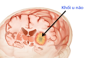 Bệnh u não là gì?