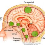 Triệu chứng, nguyên nhân khối u não: Những điều bạn nên biết